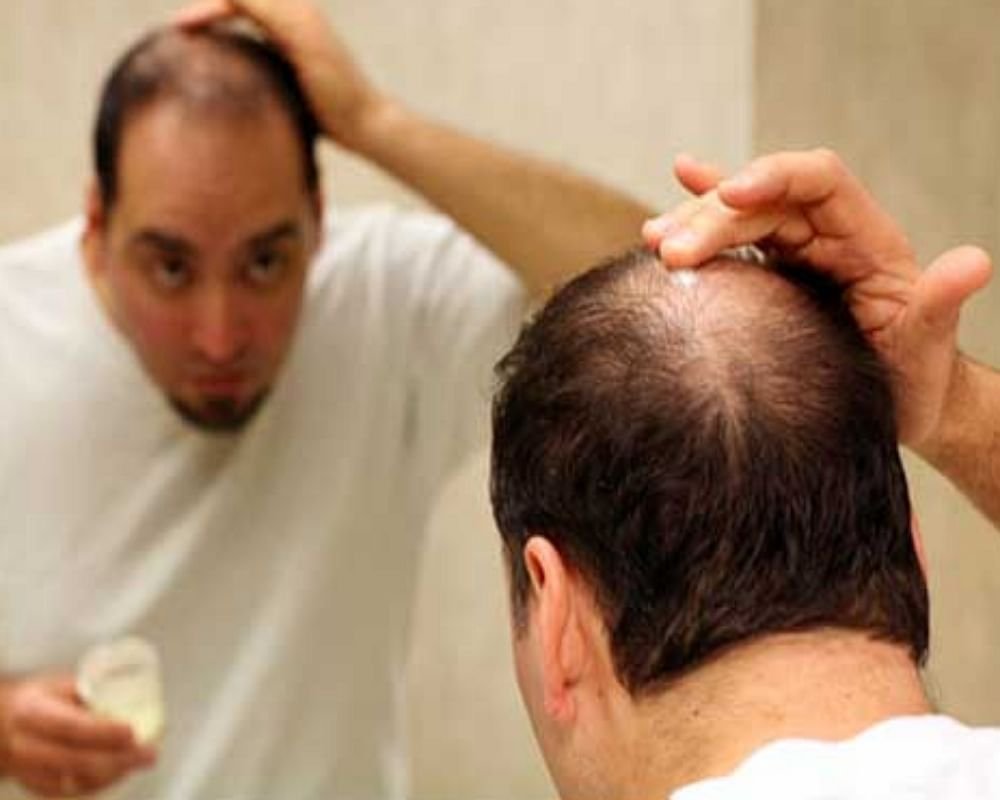 Ayurvedic Remedies For Hair Loss Treatment - बरसात आते ही झड़ने लगते हैं बाल तो ये 5 आयुर्वेदिक उपाय तुरंत दिलाएंगे राहत - Amar Ujala Hindi News Live