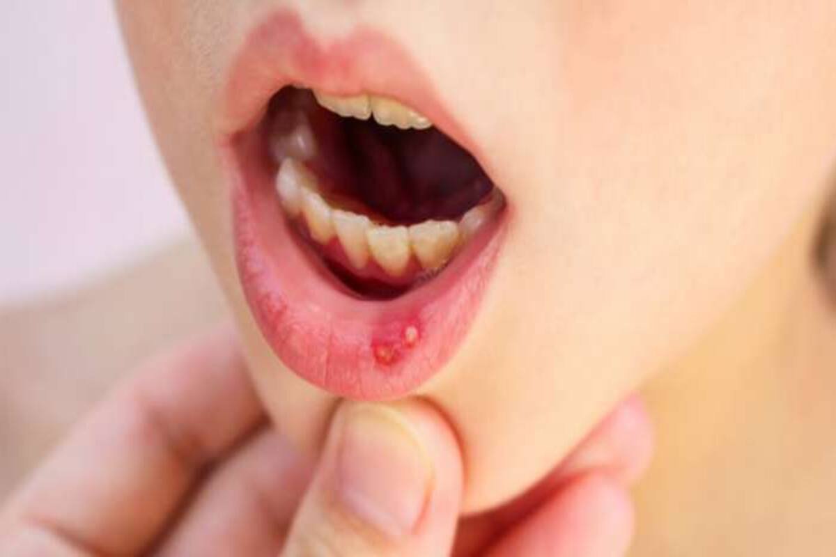 Home Remedies: बार-बार होने वाले मुंह के छालों से पाना चाहते हैं छुटकारा? आजमाएं ये घरेलू उपाय - Home remedies to cure mouth ulcers - Latest News &amp; Updates in Hindi at