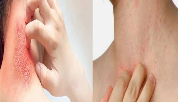 khujli ka ilaj in hindi itching treatment and cause eczema ka gharelu ilaj stmp | Khujli ka Ilaj: खुजली की समस्या से हैं परेशान, तो अपनाएं ये दमदार घरेलू नुस्खे, जड़ से