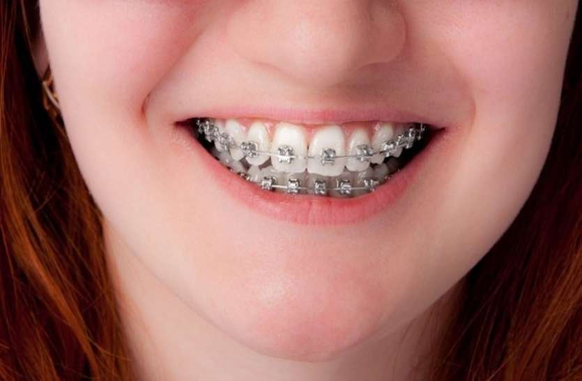 Ragged Teeth Will Be Treated Directly From This Treatment - टेढ़े-मेढ़े दांत इस इलाज से होंगे सीधे | Patrika News