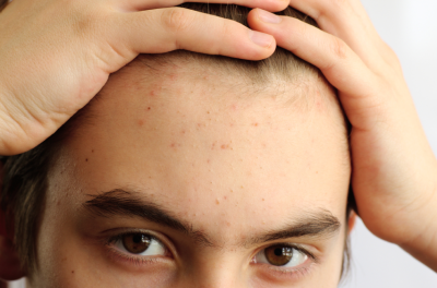 6 Easy Ways to Prevent Forehead Acne | Forehead acne, Pimples on forehead, Chest acne
