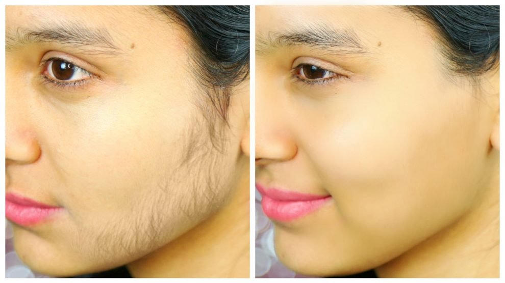 चेहरे पर अनचाहे बालों को कैसे हटाए? घरेलु उपाय how to remove face hair in hindi, home remedies