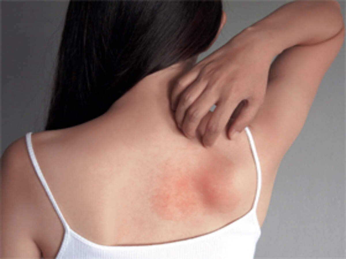 Skin Problems in Rainy Season: How To Deal With Irritated Skin In Rainy Season - बारिश के मौसम में होने वाली त्वचा की समस्याओं से ऐसे करें खुद का बचाव | Navbharat